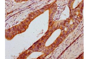 IHC image of ABIN7150742 diluted at 1:400 and staining in paraffin-embedded human colon cancer performed on a Leica BondTM system. (DUSP13 antibody  (AA 1-198))