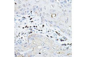 Immunohistochemistry of paraffin-embedded human esophageal cancer using NOX/p67phox Rabbit pAb (ABIN3021640, ABIN3021641, ABIN3021642, ABIN1513243 and ABIN6215468) at dilution of 1:100 (40x lens). (NCF2 antibody  (AA 227-526))