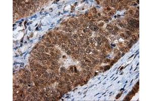 Immunohistochemical staining of paraffin-embedded Adenocarcinoma of colon tissue using anti-MTRF1L mouse monoclonal antibody. (MTRF1L antibody)