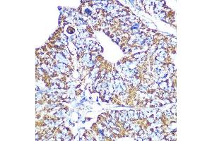 Immunohistochemistry of paraffin-embedded human colon carcinoma using HSP60/HSPD1 Rabbit mAb (ABIN1680746, ABIN3015220, ABIN3015221 and ABIN7101321) at dilution of 1:100 (40x lens). (HSPD1 antibody)