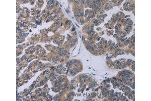 Immunohistochemistry of Human cervical cancer using TP53AIP1 Polyclonal Antibody at dilution of 1:50