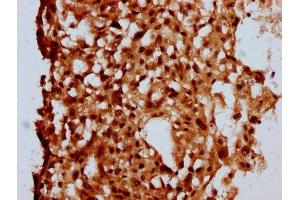 IHC image of ABIN7160108 diluted at 1:500 and staining in paraffin-embedded human melanoma performed on a Leica BondTM system.