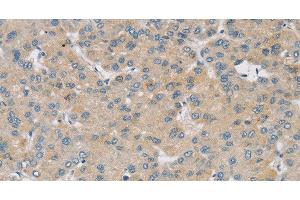 Immunohistochemistry of paraffin-embedded Human liver cancer using SMOC2 Polyclonal Antibody at dilution of 1:30 (SMOC2 antibody)
