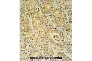 UBAC1 Antibody (C-term) (ABIN651546 and ABIN2840294) immunohistochemistry analysis in formalin fixed and paraffin embedded human prostate carcinoma followed by peroxidase conjugation of the secondary antibody and DAB staining. (UBAC1 antibody  (C-Term))