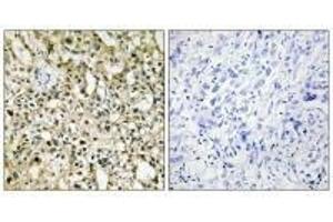Immunohistochemistry analysis of paraffin-embedded human liver carcinoma tissue using Myc antibody. (c-MYC antibody  (C-Term))