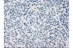 Immunohistochemical staining of paraffin-embedded Adenocarcinoma of colon tissue using anti-SSX2mouse monoclonal antibody. (SSX2 antibody)