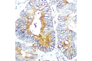 Immunohistochemistry of paraffin-embedded human colon carcinoma using Aquaporin-1 (Aquaporin-1 ) Rabbit mAb (ABIN1682901, ABIN3018679, ABIN3018680 and ABIN7101646) at dilution of 1:100 (40x lens). (Aquaporin 1 antibody)