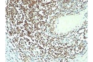 Formalin-fixed, paraffin-embedded human bladder carcinoma stained with Nucleolin antibody (364-5 + NCL/902). (Nucleolin antibody)