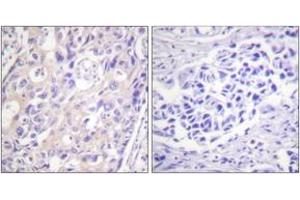 Immunohistochemistry analysis of paraffin-embedded human breast carcinoma, using p90 RSK (Phospho-Thr359+Ser363) Antibody.