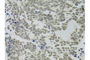 Immunohistochemistry of paraffin-embedded human lung cancer using PPP4C antibody (ABIN5971135) at dilution of 1/100 (40x lens). (PPP4C antibody)