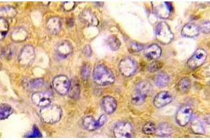 Immunohistochemistry (IHC) analyzes of BAD antibody in paraffin-embedded human breast carcinoma tissue. (BAD antibody)