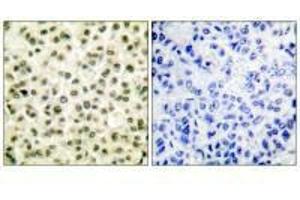 Immunohistochemical analysis of paraffin-embedded human breast carcinoma tissue using Ku70/80 antibody.