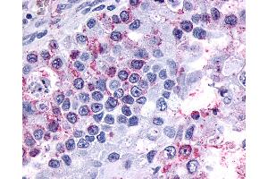Anti-GPR3 antibody IHC of human Ovary, Carcinoma. (GPR3 antibody  (Extracellular Domain))