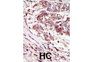 Formalin-fixed and paraffin-embedded human hepatocellular carcinoma tissue reacted with CAMK1G polyclonal antibody  , which was peroxidase-conjugated to the secondary antibody, followed by AEC staining. (CAMK1G antibody  (C-Term))