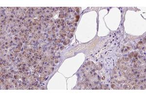 ABIN6273238 at 1/100 staining Human pancreas cancer tissue by IHC-P. (ETFA antibody  (Internal Region))