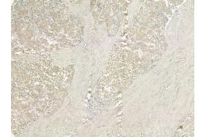 ABIN6258492 and ABIN6274927 at 1/100 staining human prostate carcinoma by IHC-P. (BCAS4 antibody  (Internal Region))