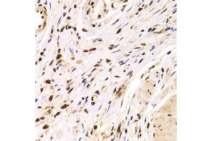 Immunohistochemistry of paraffin-embedded Human gastric cancer using PPP1R8 antibody at dilution of 1:100 (x400 lens).