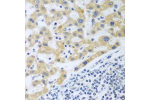 Immunohistochemistry of paraffin-embedded human liver cancer using SHBG antibody (ABIN5975291) at dilution of 1/100 (40x lens). (SHBG antibody)