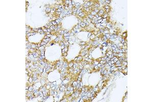 Immunohistochemistry of paraffin-embedded human colon carcinoma using MT-CO3 antibody (ABIN7266636) at dilution of 1:100 (40x lens).