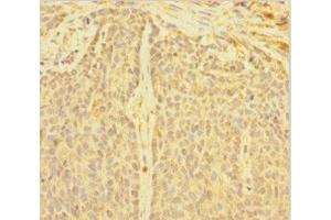 Immunohistochemistry of paraffin-embedded human ovarian cancer using ABIN7149718 at dilution of 1:100 (DNTTIP1 antibody  (AA 1-329))