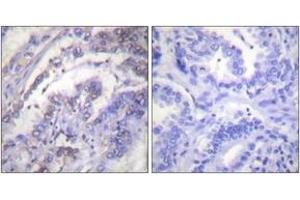 Immunohistochemistry analysis of paraffin-embedded human lung carcinoma tissue, using Histone H3 (Ab-3) Antibody. (Histone 3 antibody  (AA 1-50))