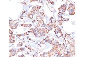 Immunohistochemistry of paraffin-embedded Human breast cancer using UBE2O Polyclonal Antibody at dilution of 1:100 (40x lens).