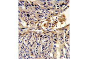 Formalin-fixed and paraffin-embedded human lung carcinoma reacted with EX2 Antibody (Center), which was peroxidase-conjugated to the secondary antibody, followed by DAB staining. (APEX2 antibody  (AA 143-171))