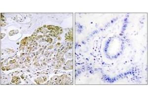 Immunohistochemistry analysis of paraffin-embedded human lung carcinoma tissue, using TFEB Antibody.