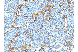 Formalin-fixed, paraffin-embedded human Melanoma stained with NGFR Monoclonal Antibody (NTR/912). (NGFR antibody)
