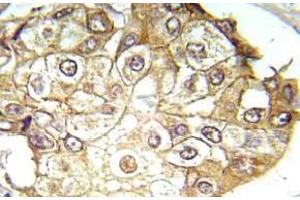 Immunohistochemistry (IHC) analyzes of p-ERK1/2 antibody in paraffin-embedded human breast carcinoma tissue. (ERK1 antibody  (pThr202, pTyr204))