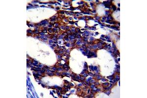 Paraformaldehyde-fixed, paraffin embedded human breast carcinoma, Antigen retrieval by boiling in sodium citrate buffer (pH6. (TGFB2 antibody)