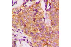 Immunohistochemical analysis of GSK3 beta (pS9) staining in human breast cancer formalin fixed paraffin embedded tissue section. (GSK3 beta antibody  (N-Term, pSer9))