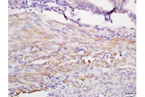 Formalin-fixed and paraffin embedded human endometrium labeled with Anti-IGFBP1 Polyclonal Antibody, Unconjugated (ABIN734948) at 1:200 followed by conjugation to the secondary antibody and DAB staining (IGFBPI antibody  (AA 150-250))