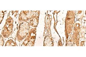 Immunohistochemistry of paraffin-embedded Human liver cancer tissue using WDR33 Polyclonal Antibody at dilution of 1:65(x200) (WDR33 antibody)