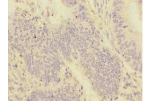 Immunohistochemistry of paraffin-embedded human colon cancer using ABIN7159959 at dilution of 1:100 (PMPCA antibody  (AA 456-525))