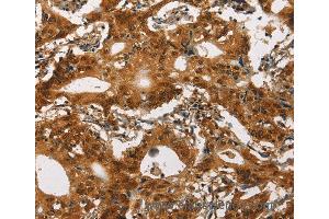 Immunohistochemistry of Human thyroid cancer using CACNA1C Polyclonal Antibody at dilution of 1:30