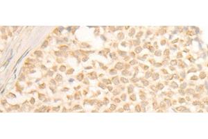 Immunohistochemistry of paraffin-embedded Human ovarian cancer tissue using CYP4X1 Polyclonal Antibody at dilution of 1:40(x200) (CYP4X1 antibody)