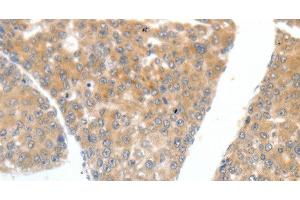 Immunohistochemistry of paraffin-embedded Human liver cancer tissue using FSHR Polyclonal Antibody at dilution 1:70 (FSHR antibody)