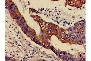 IHC image of ABIN7159999 diluted at 1:600 and staining in paraffin-embedded human colon cancer performed on a Leica BondTM system. (ERK1 antibody  (AA 11-379))