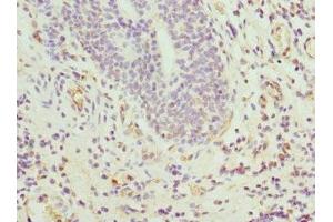 Immunohistochemistry of paraffin-embedded human bladder cancer using ABIN7144067 at dilution of 1:100 (CIAPIN1 antibody  (AA 1-312))