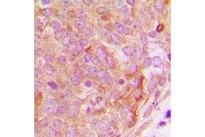 Immunohistochemical analysis of PP15 staining in human breast cancer formalin fixed paraffin embedded tissue section.
