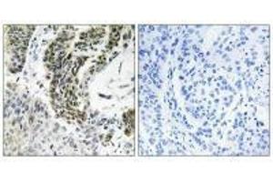 Immunohistochemistry analysis of paraffin-embedded human lung carcinoma tissue using RREB1 antibody.