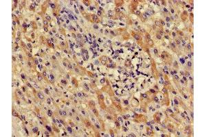 Immunohistochemistry of paraffin-embedded human liver cancer using ABIN7164407 at dilution of 1:100 (LDHD antibody  (AA 310-507))