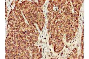 Immunohistochemistry of paraffin-embedded human ovarian cancer using ABIN7169308 at dilution of 1:100 (PPP1CB antibody  (Catalytic Subunit))