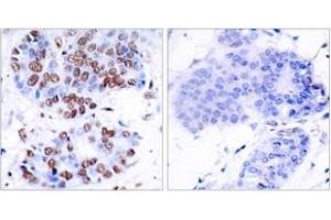 Immunohistochemistry analysis of paraffin-embedded human breast carcinoma tissue, using NF-kappaB p65 (Ab-276) Antibody. (NF-kB p65 antibody  (AA 249-298))
