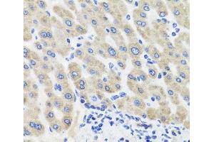 Immunohistochemistry of paraffin-embedded Human liver damage using HSD11B2 Polyclonal Antibody at dilution of 1:100 (40x lens).