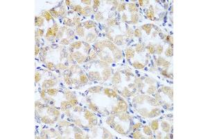 Immunohistochemistry of paraffin-embedded human stomach cancer using ANKRD52 antibody at dilution of 1:100 (40x lens). (ANKRD52 antibody)