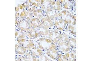 Immunohistochemistry of paraffin-embedded human stomach cancer using ANKRD52 antibody at dilution of 1:100 (40x lens).