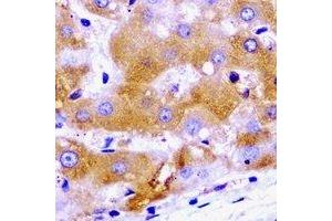Immunohistochemical analysis of SCYL1 staining in human liver cancer formalin fixed paraffin embedded tissue section.