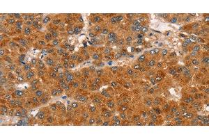 Immunohistochemistry of paraffin-embedded Human liver cancer tissue using RASA3 Polyclonal Antibody at dilution 1:35 (RASA3 antibody)